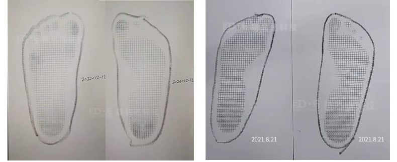 3d打印矫形鞋垫